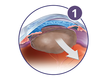 Diagram of cataract removal showing a cloudy natural lens being broken up and removed through a small incision.