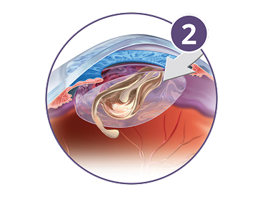 Diagram of lens insertion showing an artificial intraocular lens being placed inside the eye after cataract removal.