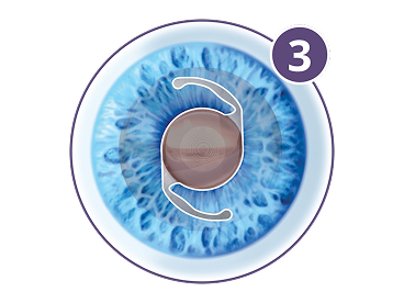 Illustration of a clear eye with an implanted intraocular lens, representing improved vision after cataract surgery.